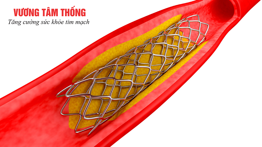 Hình ảnh stent đặt vào trong mạch vành.jpg